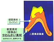 二層構造義歯